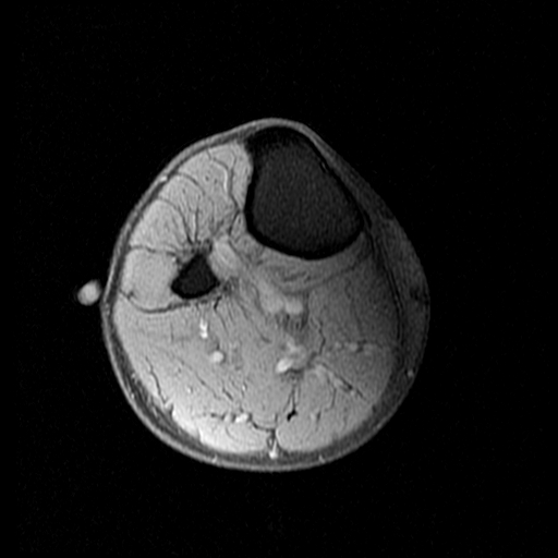 Figure 5 for case Schwannoma ( RID4473 )
